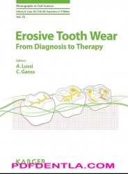 Erosive Tooth Wear - From Diagnosis to Therapy Monographs in Oral Science, Vol. 25 (pdf)